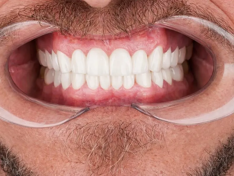 Implant & Zirconia Crown — after treatment